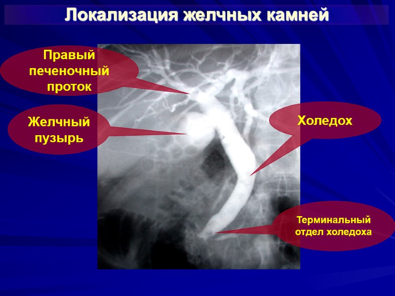 Локализация желчных камней Желчный пузырь Холедох Правый печеночный проток Терминальный отдел холедоха